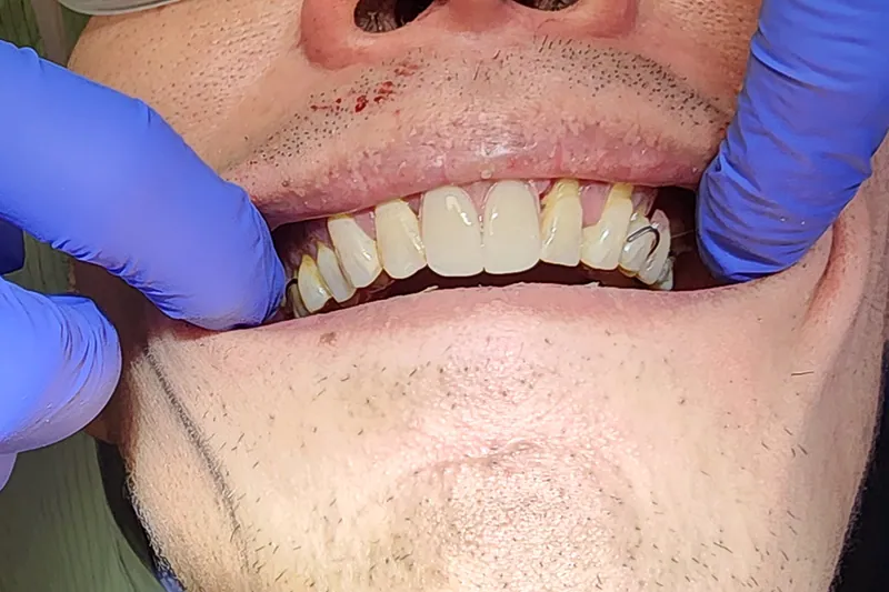 Teeth after treatment