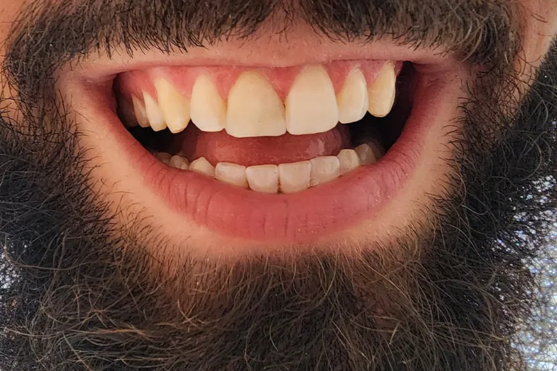 Teeth after treatment