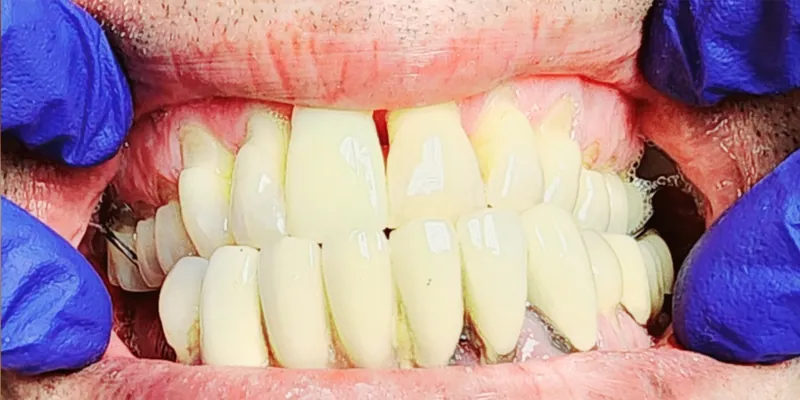 Teeth after treatment
