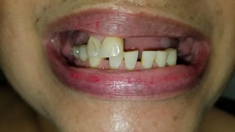Teeth before treatment
