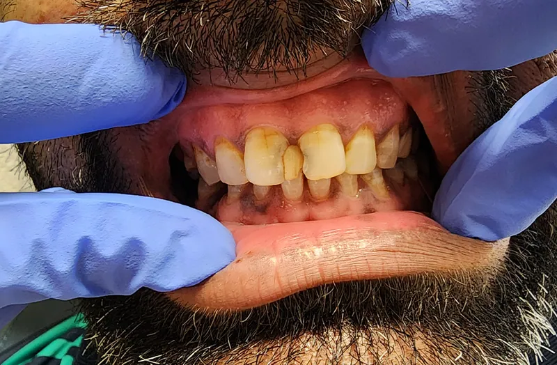 Teeth before treatment