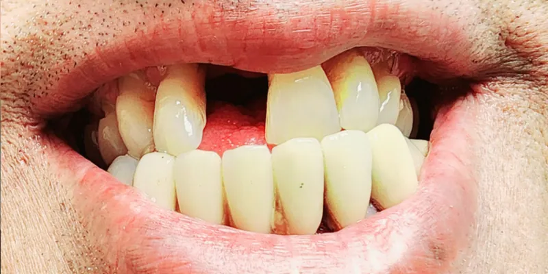 Teeth before treatment