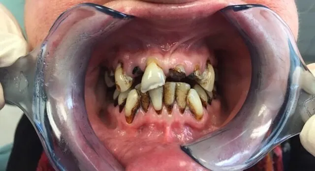 Teeth before treatment